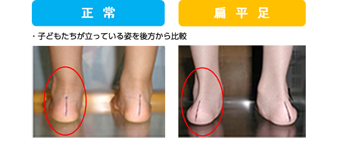 扁平足|幼児、小児を中心とした(成人も対応可能)、内股、X脚、O脚を手術せずに矯正します