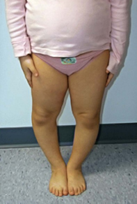 3歳以降はX脚に見え、6~8歳になると脚がまっすぐに伸びます。 しかし、3歳未満でも重度のO脚がみられる場合、初期診断と管理が重要です。