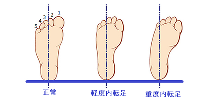 足 が 内側 に 入る