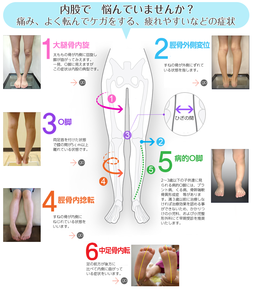 小学生の内股を矯正器具で治療します